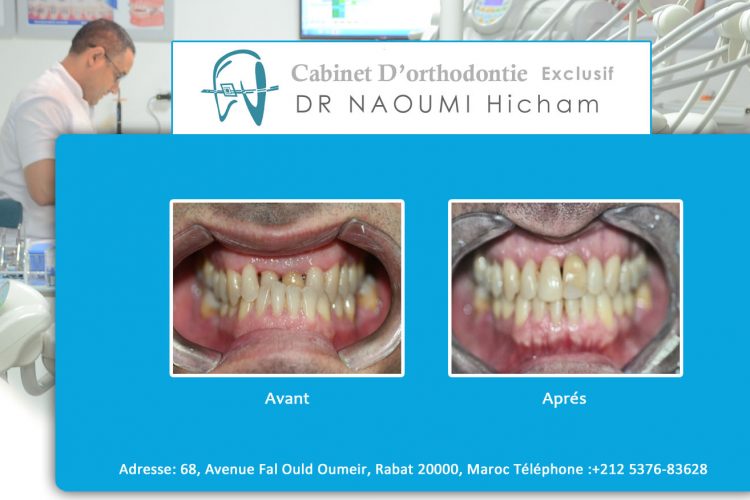 Cas 1 cabinet d orthodontie Exclusif dr naoumi hicham agdal rabat