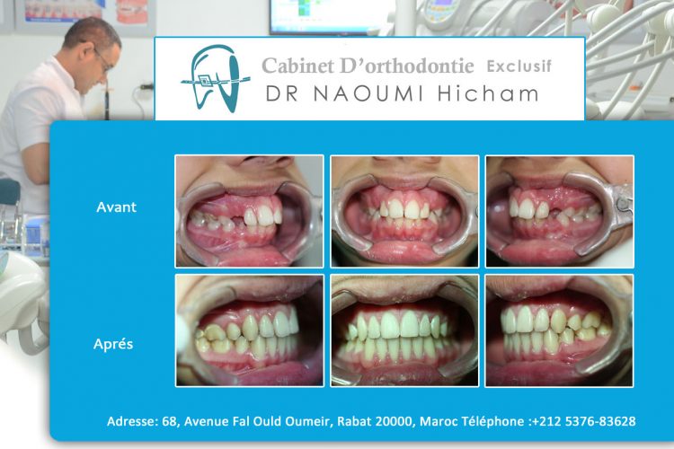 Cas 10 cabinet d orthodontie Exclusif dr naoumi hicham agdal rabat