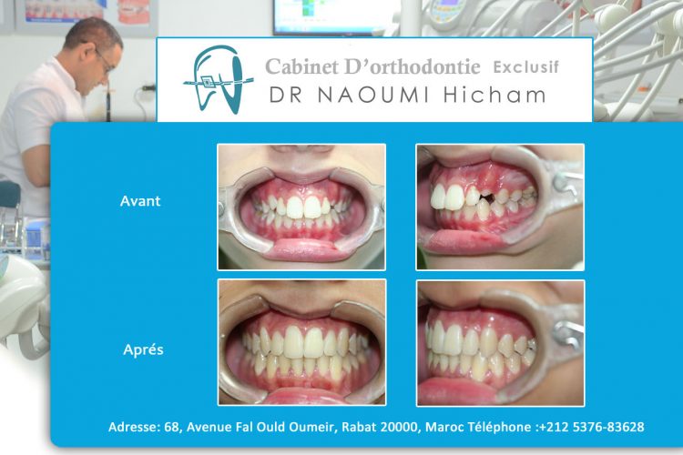 Cas 11 cabinet d orthodontie Exclusif dr naoumi hicham agdal rabat