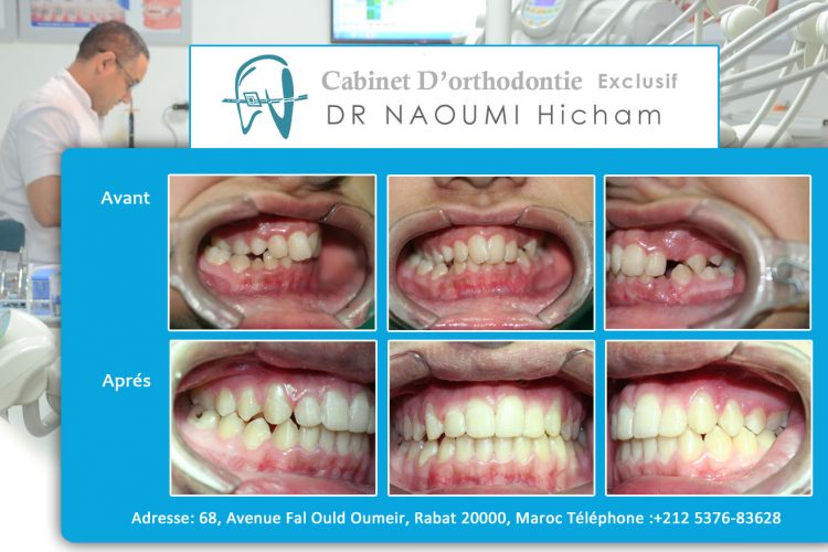 Cas 14 cabinet d orthodontie Exclusif dr naoumi hicham agdal rabat