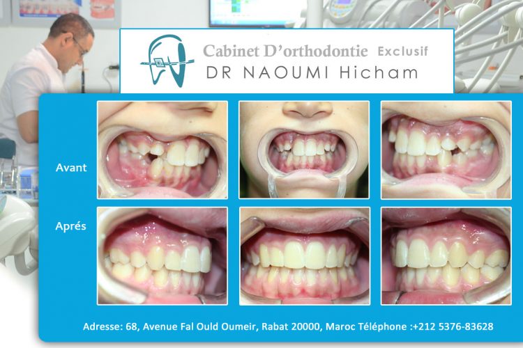 Cas 15 cabinet d orthodontie Exclusif dr naoumi hicham agdal rabat