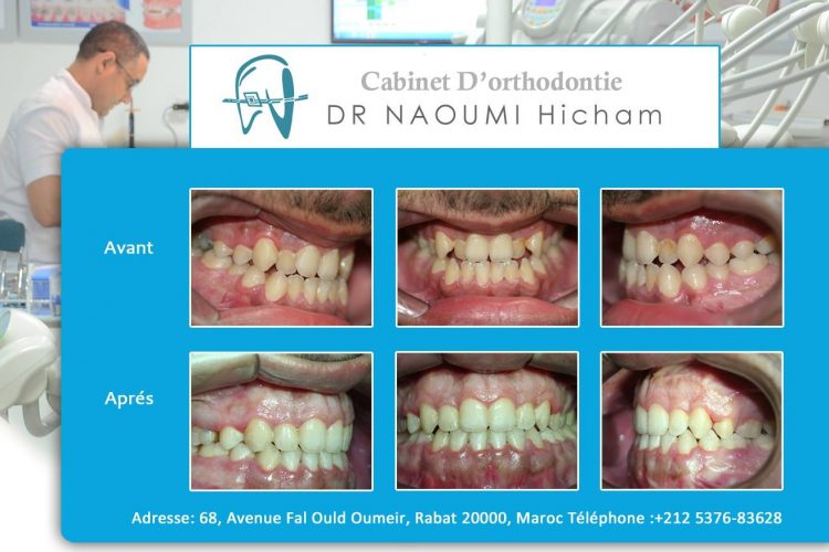Cas 17 cabinet d orthodontie Exclusif dr naoumi hicham agdal rabat