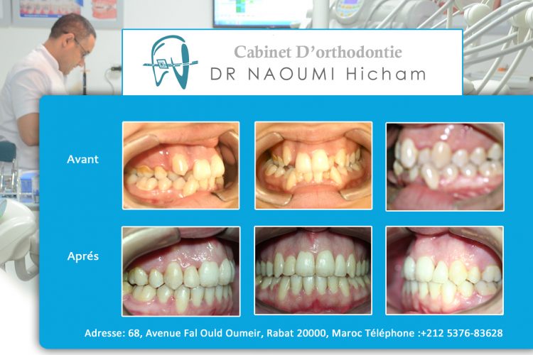 Cas 18 cabinet d orthodontie Exclusif dr naoumi hicham agdal rabat