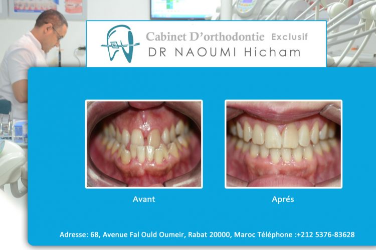 Cas 2 cabinet d orthodontie Exclusif dr naoumi hicham agdal rabat