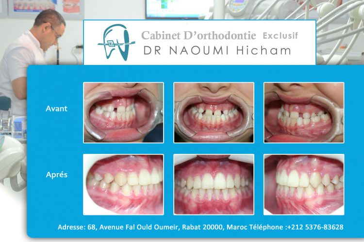 Cas 4 cabinet d orthodontie Exclusif dr naoumi hicham agdal rabat