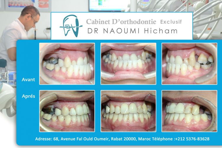 Cas 5 cabinet d orthodontie Exclusif dr naoumi hicham agdal rabat