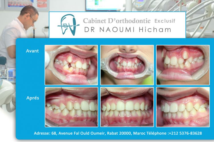 Cas 7 cabinet d orthodontie Exclusif dr naoumi hicham agdal rabat