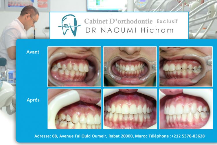 Cas 8 cabinet d orthodontie Exclusif dr naoumi hicham agdal rabat