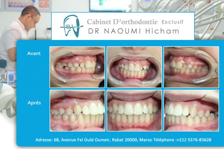 Cas 9 cabinet d orthodontie Exclusif dr naoumi hicham agdal rabat